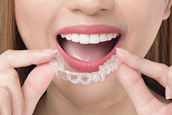The Ultimate Invisalign Guide